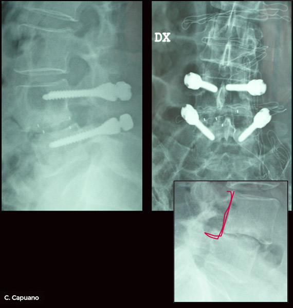 Spondilolistesi-POSToperatoria