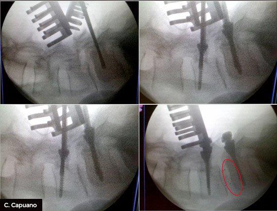 Spondilolistesi-intraoperatoria