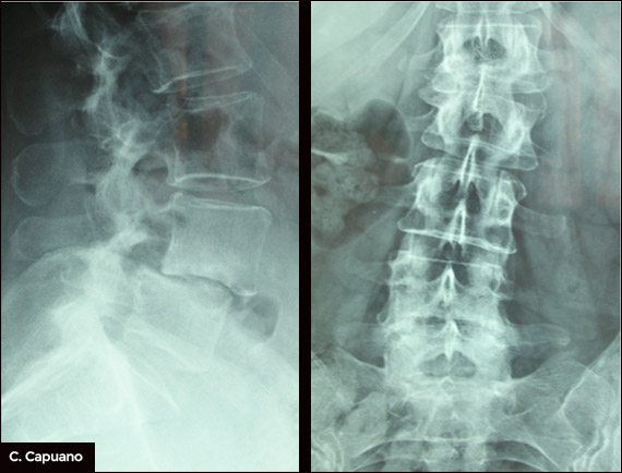 Spondilolistesi-preoperatoria