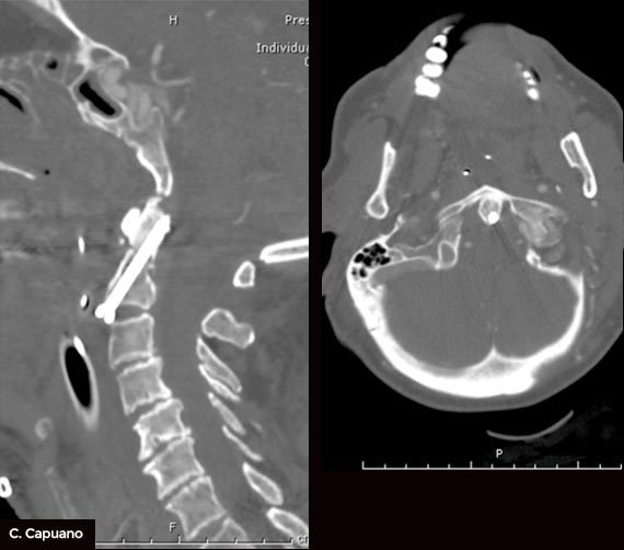 FRATTURA-cervicale-post