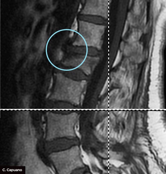 TRAUMA-LOMBARE-RMC