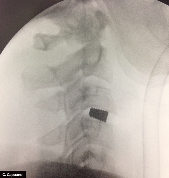 ernia-cervicale-RX-postoperatoria