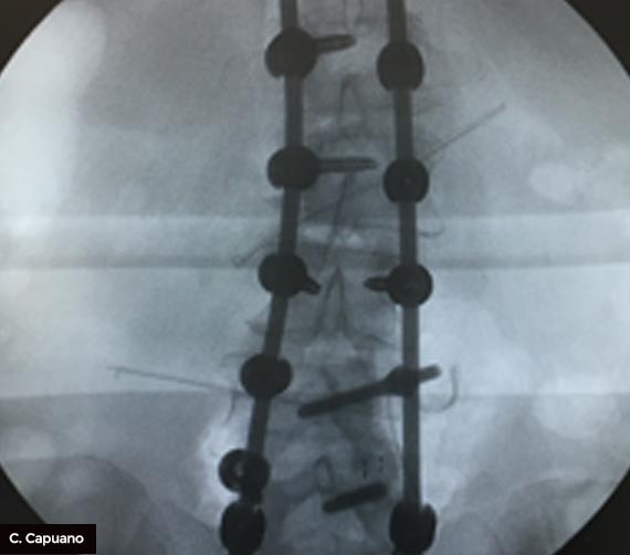Microchirurgia Scoliosi-post